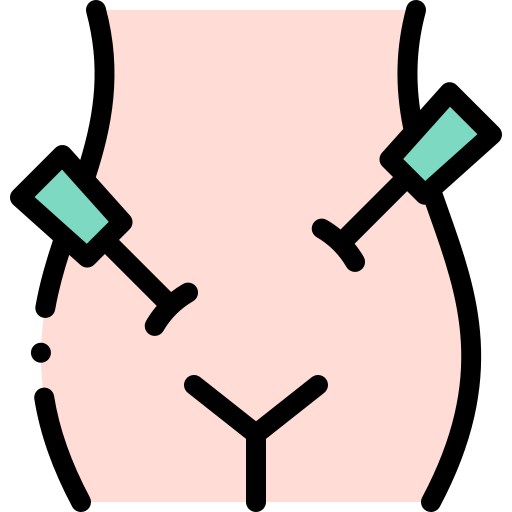 LAPAROSCOPIC HYSTERECTOMY